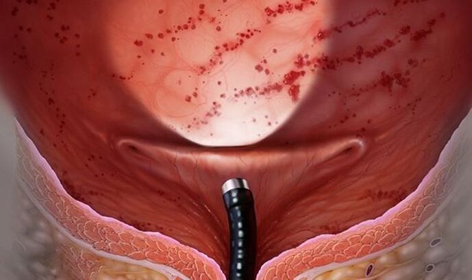 Zystitis